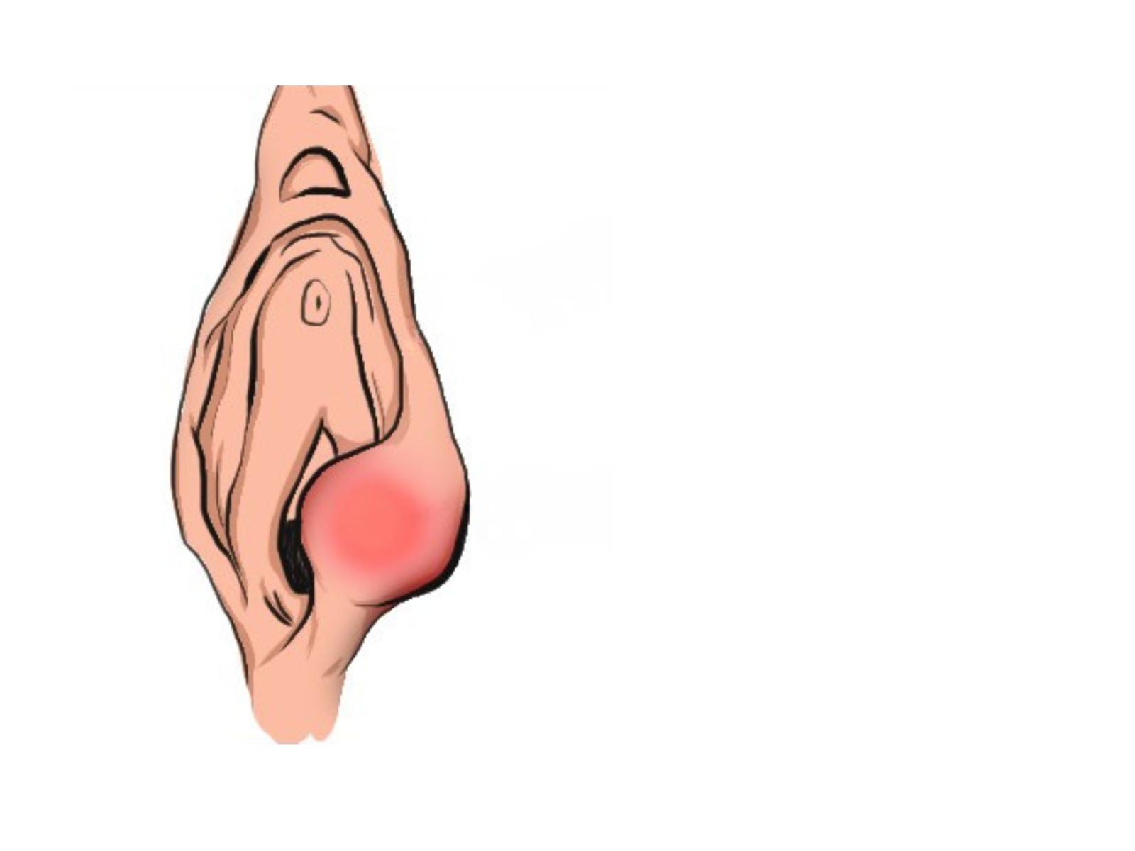 解決私密處暗瘡